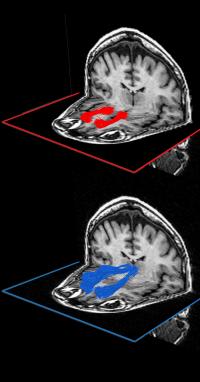 j neurosci:脑白质影响我们做决定