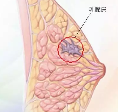 2016年乳腺癌治疗的3大突破