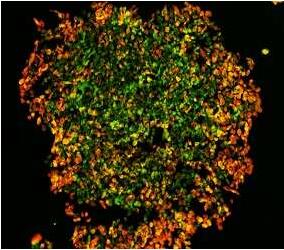 EBioMedicine：科学家或有望开发出抵御黑色素瘤扩散的新疗法