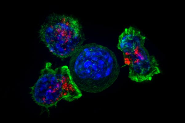 Nat Med：科学家发现一种抑制抗肿瘤免疫细胞的新细胞