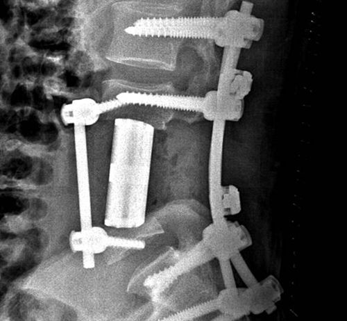 3D打印换脊骨！南医三院开展全省首例3D打印人工椎体植入手术