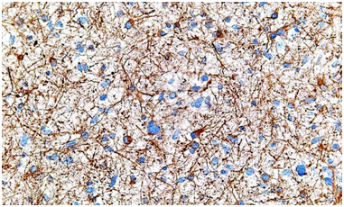 脑癌细胞显微图片,图片来自 wikimedia/cc by-sa 3.0