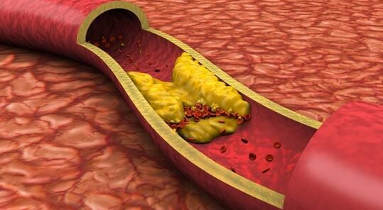 重磅级文章解读动脉粥样硬化研究进展