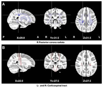 Front Neuroanat：HIV感染似乎会伤害儿童的大脑发育