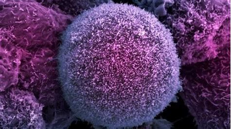 Cancer&#160;Res：徐州医科大发现促进乳腺癌侵袭转移的新癌基因