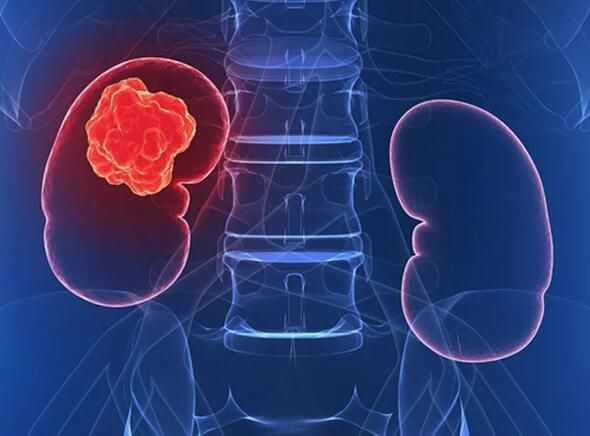 诱发肾癌的“种子”或许早已在每个人的青春期就已经播下了