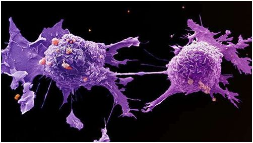 显微镜观察下的肺癌细胞.图片来自lri em unit.