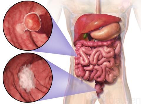 结直肠癌的发生为何越来越年轻化?