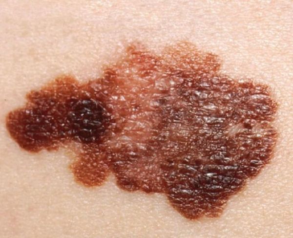 journal上的研究报告中,来自加拿大的科学家们对黑色素瘤这种恶性皮肤