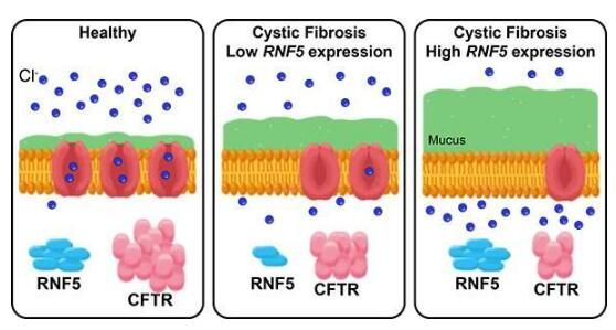 elife:为何某些囊性纤维化患者并不易发生感染?原来是关键基因在帮忙!