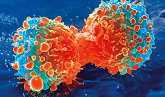 Nature：通过靶向作用癌症干细胞或有望根治急性髓性白血病