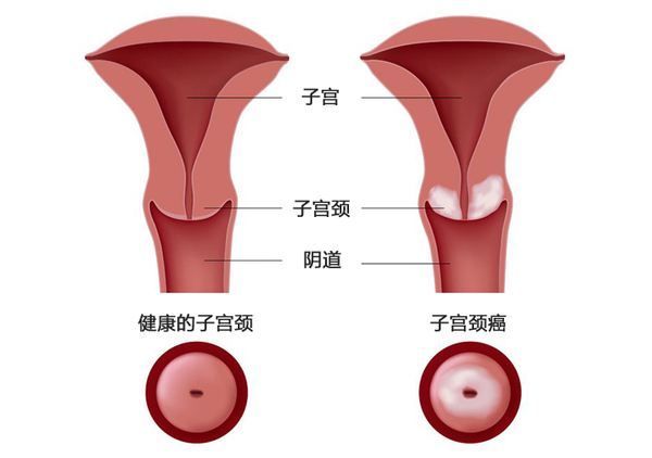 宫颈癌靶向疗法!