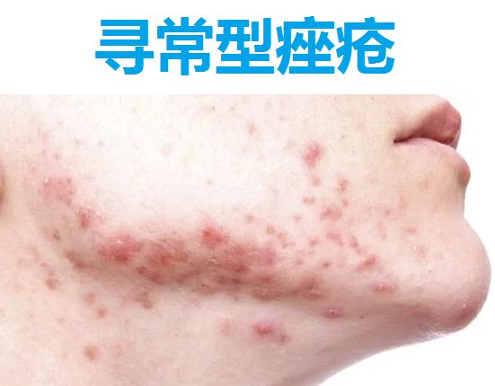 寻常型痤疮(图片来源:premier-clinic.com)